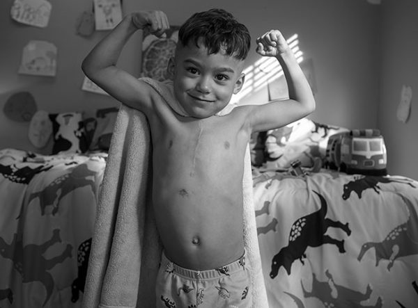 来自黎巴嫩的5岁男孩JuJu Rivera在宾州儿童医院接受了三次心脏手术，他站在卧室里用双臂锻炼肌肉。他胸前有一个垂直的伤疤，背上披着一条毛巾，就像超级英雄的斗篷和睡裤。在他身后，他的床上盖着一个装饰着恐龙的床罩。