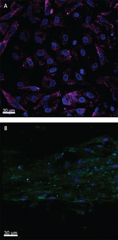 Isolated posterior tibial tendon-derived stem cells (TSCs) from diseased tenopathic tendon.