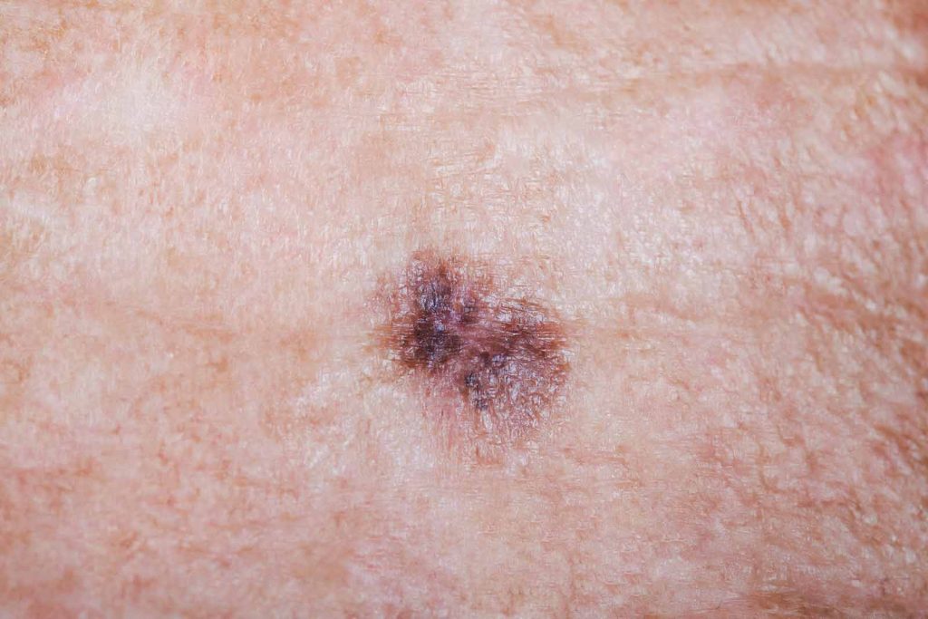 A close-up of a brown melanoma is shown on a man’s forehead. There are two stitches holding the biopsy site together.
